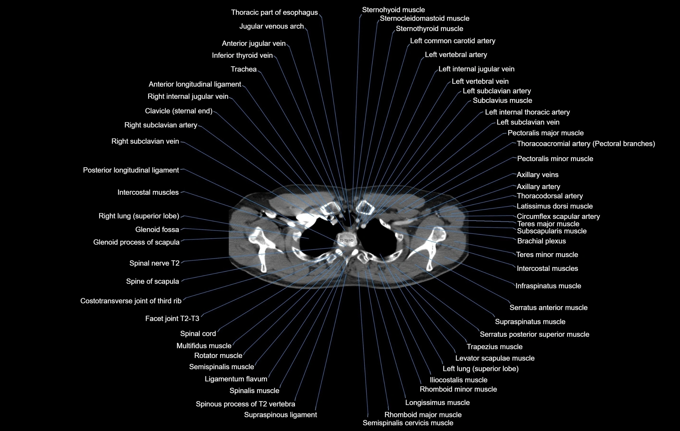 CT chest (thorax) soft tissue window labelled axial cross sectional anatomy radiology image-00014.webp